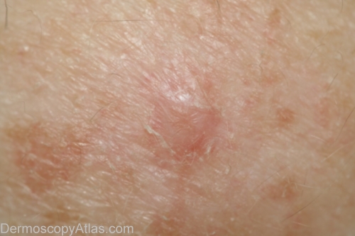 Amelanotic Melanomas Presenting as Red Skin Lesions: A ...